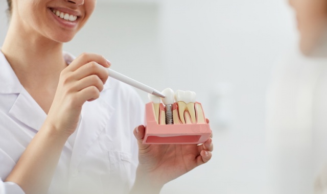 Uno o più denti mancanti? l’implantologia a carico immediato può essere la soluzione