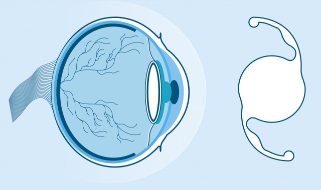 Elimina cataratta e difetti visivi con le lenti intraoculari IOL Premium