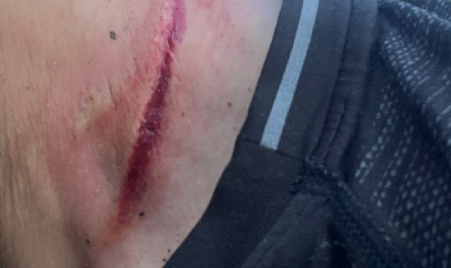 Il cavo d’acciaio collocato da ignoti tra due alberi, con a un’estremità un cappio. Sotto, al centro, le lesioni al collo dell’endurista