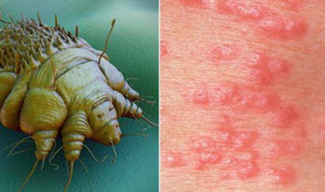 Caso di scabbia in una scuola di Nerviano